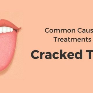 Cracked Tongue