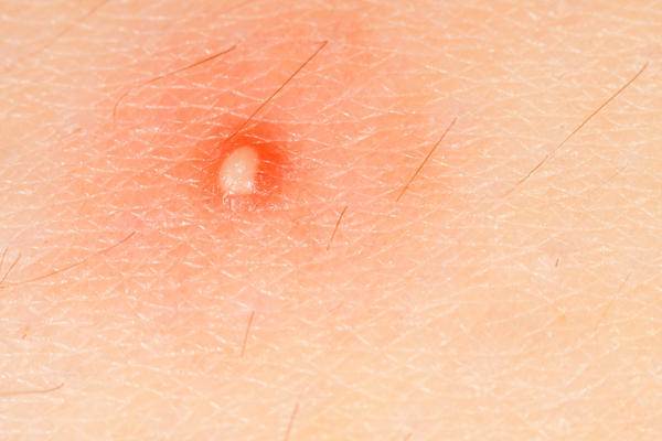 Dermatofibroma
