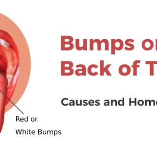 Bumps on back of tongue