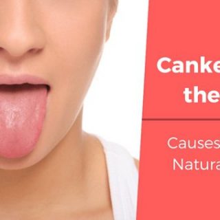Canker Sores on Tongue