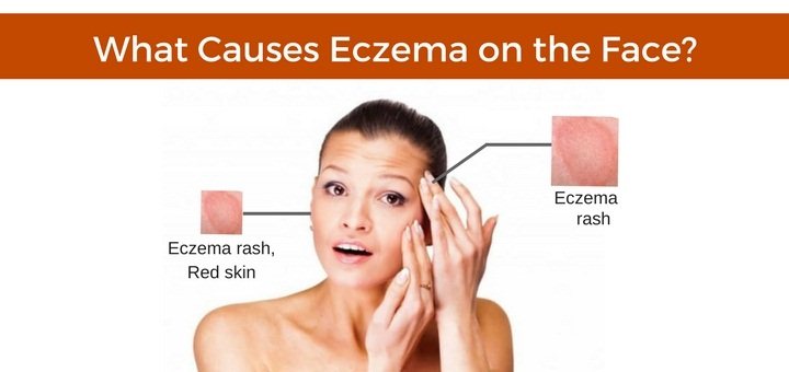 Eczema on face