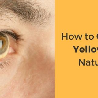 How to Get Rid of Yellow Eyes