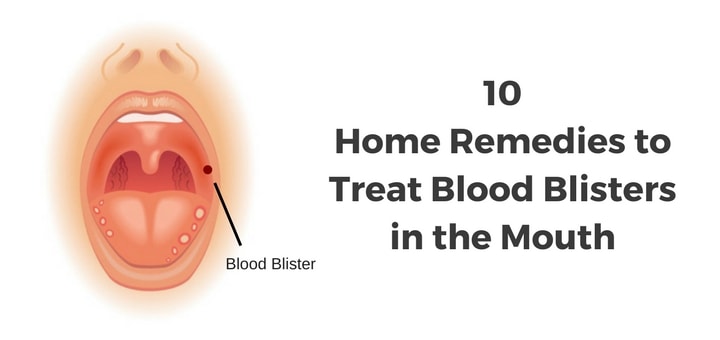 Blood Blisters in Mouth