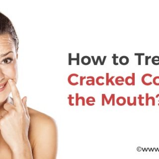 Cracked corners of mouth