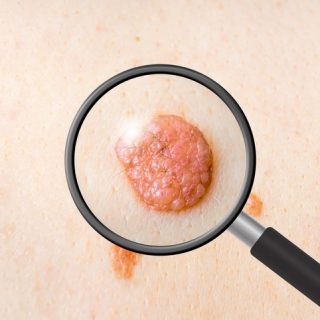 Red Moles
