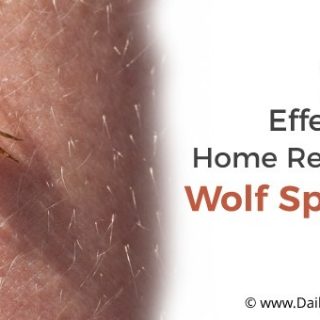 Wolf Spider Bite Treatment