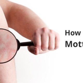 Mottled Skin