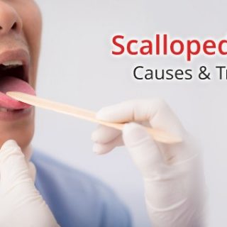 Scalloped tongue
