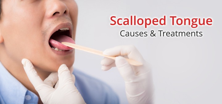 Scalloped tongue
