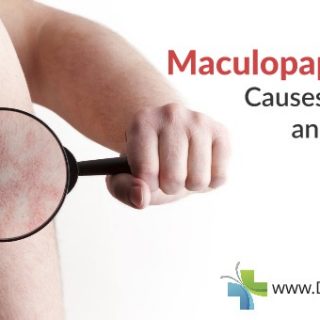 Maculopapular Rash