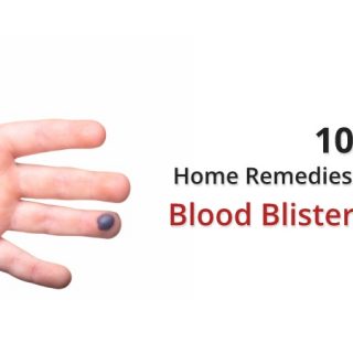 Blood blister on finger