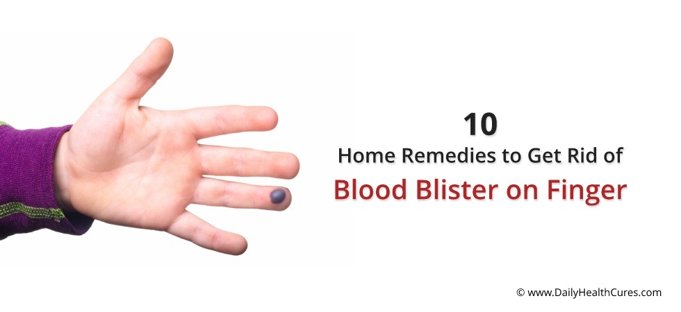 Blood blister on finger