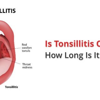 Is Tonsillitis Contagious? How Long Will It Be Contagious?