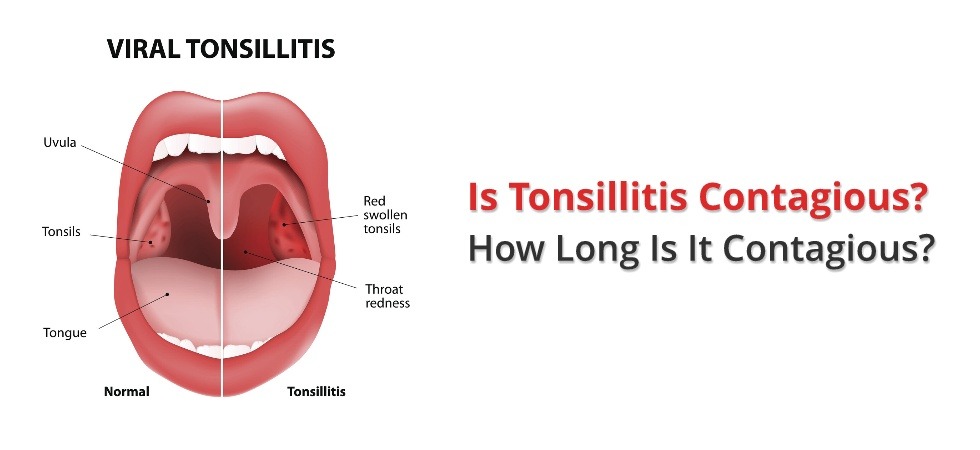 Is Tonsillitis Contagious? How Long Will It Be Contagious?