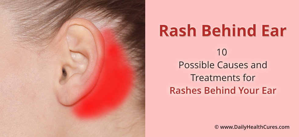 Rash behind ear