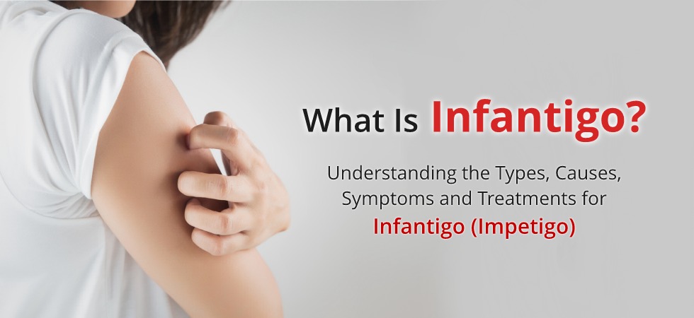 Infantigo