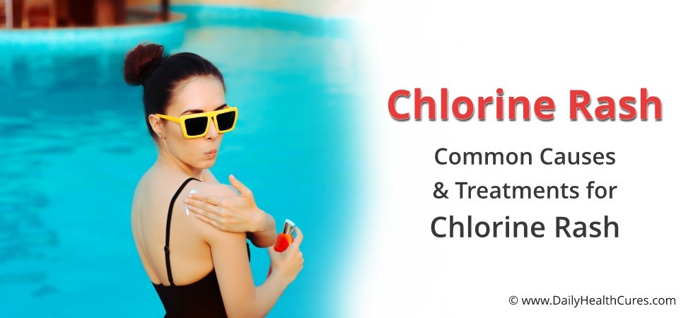 Chlorine rash