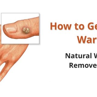 How to get rid of warts