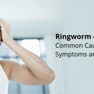 Ringworm on scalp