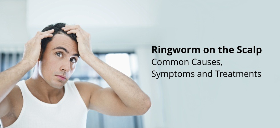 Ringworm on scalp