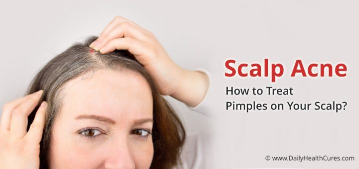 To scalp acne how get of rid How to