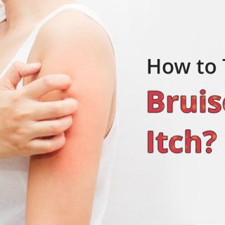 Bruises that itch
