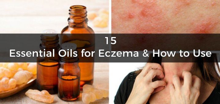 Essential oils for eczema