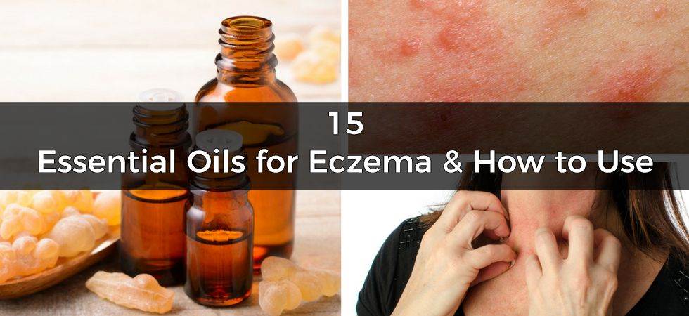 Essential oils for eczema