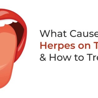 Herpes on tongue