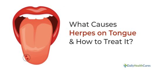 Herpes Auf Der Zunge Bilder www.dailyhealthcures.com