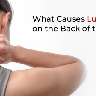 Lump on the back of the neck