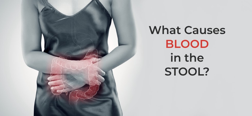 What Does Blood In Stool Look Like Home Remedies For Rectal Bleeding