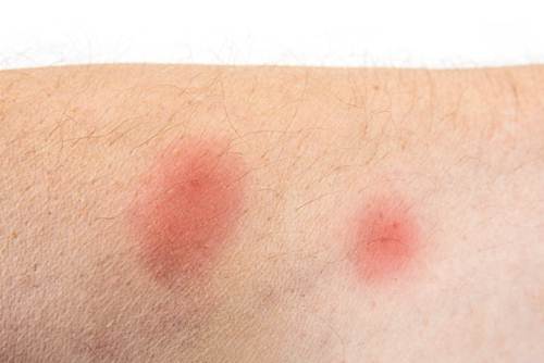 How to Treat Brown Recluse Spider Bite? (And, Prevention Tips)