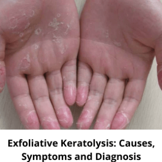 Exfoliative keratolysis