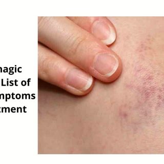 Hemorrhagic Diathesis