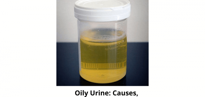 Oily Urine Causes, Symptoms and Treatment
