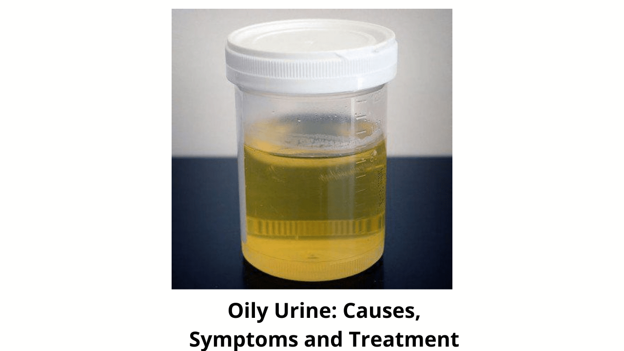 Oily Urine Causes, Symptoms and Treatment