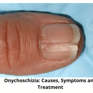 Onychoschizia
