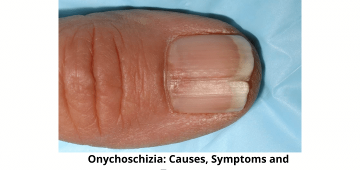 Onychoschizia