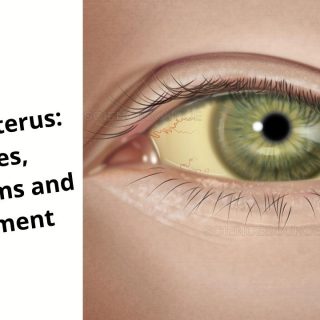 Scleral Icterus: List of Causes, Symptoms and Treatment P