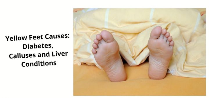 Yellow Feet Causes Diabetes, Calluses and Liver Conditions