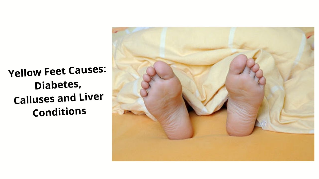 Yellow Feet Causes Diabetes, Calluses and Liver Conditions