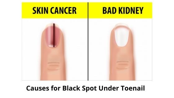 causes of black spot under toe nail