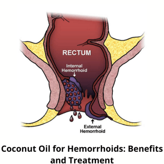 coconut oil for hemorrhoids