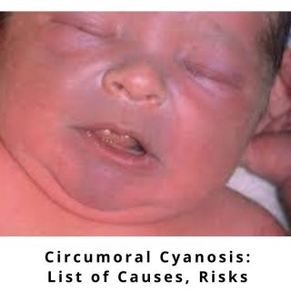 Circumoral Cyanosis