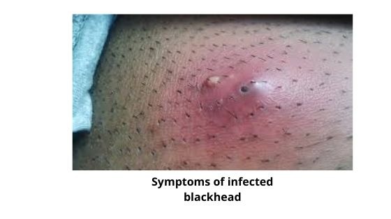Symptoms of infected blackheads