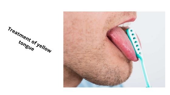 Treatment of yellow tounge