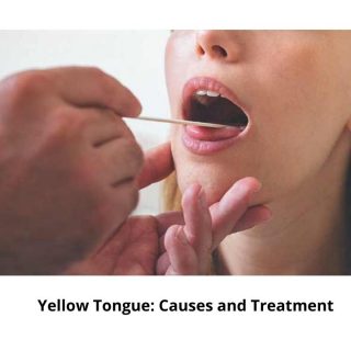 Yellow Tongue causes and treatment