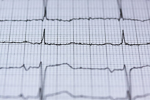 ECG Chart